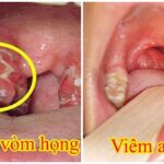 Nhiều người bị UT vòm họng nhưng cứ nghĩ là viêm amidan: BS chỉ cách phân biệt nhờ triệu chứng đi kèm