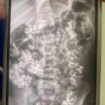 Mother horrified after 9-year-old son with autism eats handfuls of gravel at school