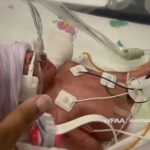 Preemie in a coma after ER staff leaves her in amniotic sac during surprise delivery