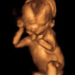 Abortion cannot be a ‘human right’ because it infringes on the right to life
