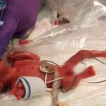 World’s smallest surviving baby born at 23 weeks celebrated by pro-life advocates