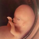 Woman shares images of miscarried baby to show humanity of life at 10 weeks