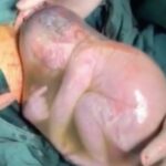 Paramedics Save 26 Week Premature Baby Still in His Amniotic Sac