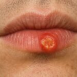 Crusty sore on my lip won’t go away. Appointment is impossible to get right now. What is this?