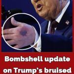 Trump explains the heavy bruise on his left hand came from ‘clipped it on the table’
