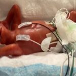 World’s youngest preemie, born just over 21 weeks, celebrates his fourth birthday