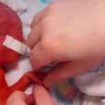 Baby Born On Day Before Abortion Limit Survives, Her Skin Was So Thin You Can See Her Brain