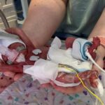 Premature Baby Born at 25 Weeks Survives, Her Skin Was So Transparent You Could See Her Veins