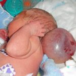 Baby Born With Brain Outside Her Skull Thrives After Parents Reject Abortion