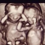 Mom Pregnant With Twins Leaves Abortion Clinic After Changing Her Mind