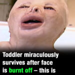 Toddler gets 90 percent burns and survives house blaze against all odds – this is her today