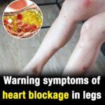 Your feet can warn you about clogged arteries and heart disease